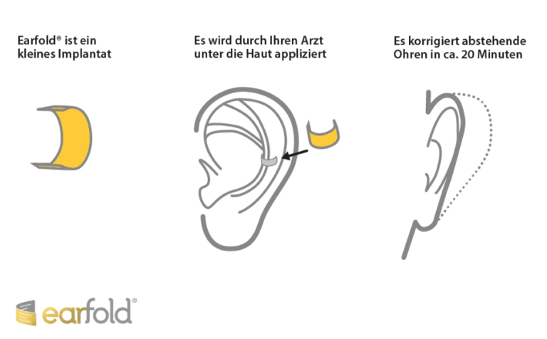 earfold methode ohren anlegen ohne Faden